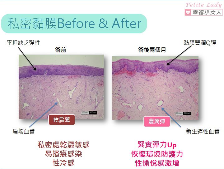 Before-and-after-vaginal-laser-surgery